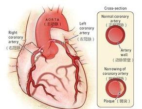 为什么心脏支架术后要吃两种抗血小板药物 