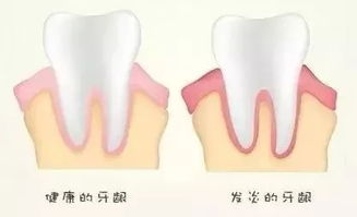 为什么牙齿牙龈不痛又没有伤口,好端端的也会出血