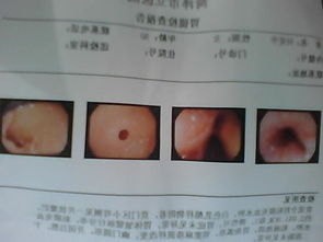 糜烂性胃炎到底严重不严重 