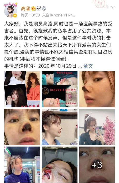 女艺人自爆整容失败鼻尖发黑照吓坏网友 米粒分享网 Mi6fx Com