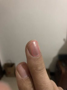 指甲上有一条竖纹,黑黑的,跟着指甲一起长出来的,都几年了,是什么 怎么回事啊 求解答 