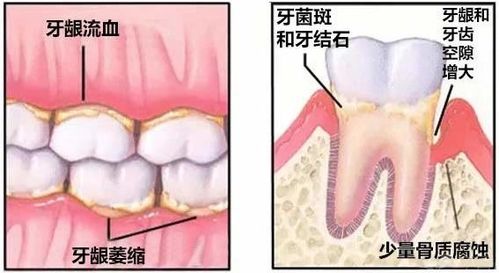 洗牙有哪些误区