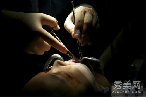 五名韩国模特接受血腥整容手术 