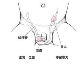 隐睾会影响寿命吗 