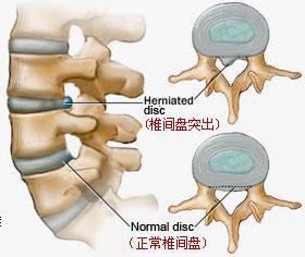 中医如何治疗腰椎盘突出