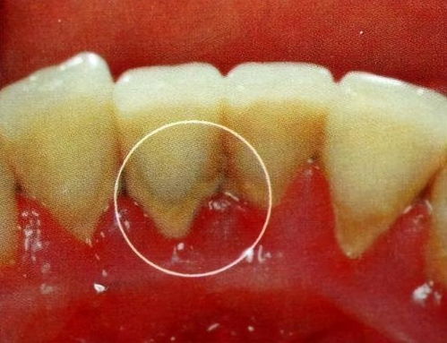 为什么外国老人80岁不掉牙,中国老人的牙齿却提前掉落