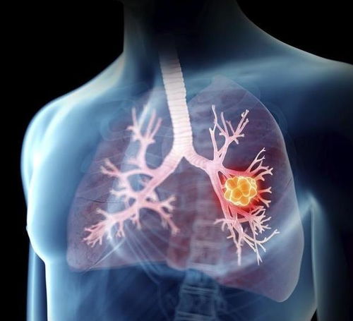 肺癌的治疗越早越好,这里的 早 体现在哪些方面