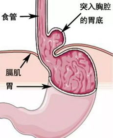 那些症状的病人需要到疝专科门诊就诊 