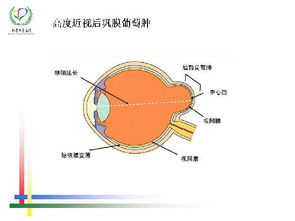 后巩膜手术专家建议做吗(有什么利害)(后巩膜技术成熟吗)