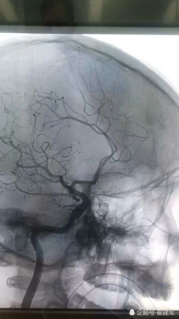 脑血管造影的危害有哪些(脑血管造影的副作用及其危害)