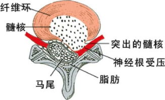 腰椎间盘突出,千万不要动手术 