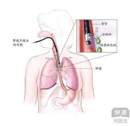 食物加工不当可导致食道癌 防食道癌该怎么做