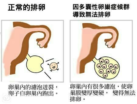 越来越汉子 你可能是患上了多囊卵巢综合征