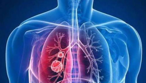 患肺结节的人越来越多 多吃2黄,或有助于结节消散,保护肺部