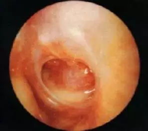 中耳炎手术 中耳炎能手术吗