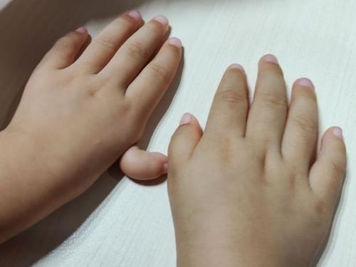 孩子右手拇指发育不良,左手漂浮拇,应该怎么办