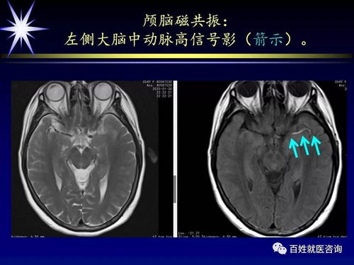 生气,真能气出病 核磁共振刚刚证实