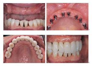 镶牙齿，种牙和镶牙有什么区别