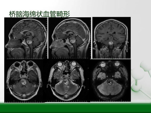 脑干海绵状血管瘤需要手术治疗吗 能打伽玛刀吗