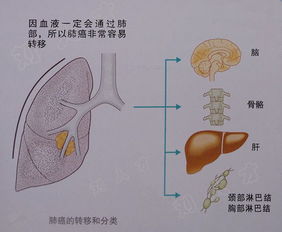 肺癌的科普防治及保障方案 