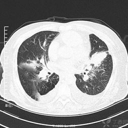 肺部病变请呼吸科专家指导
