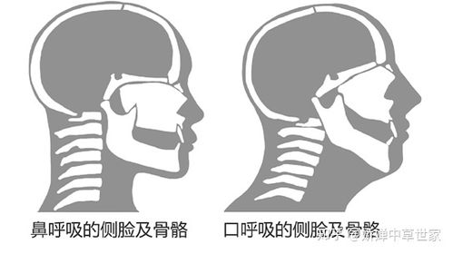 从小患鼻炎会影响长相吗 