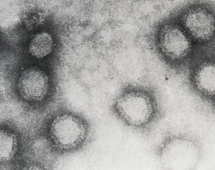 孕妇风疹图片，孕妇感染风疹病毒有什么典型症状