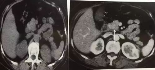 胰腺占位 CT 片不会看 这里一文教你掌握