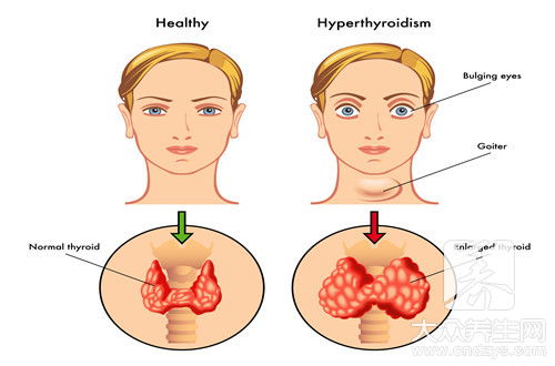 对于甲亢,我们常在饮食上有一些纠结不已的疑问,下面为大家介绍
