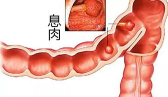 技术先锋 ▎内镜微创不开刀巧除多个胃 肠息肉