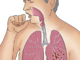 肺纤维化的症状 肺部纤维化的症状是什么