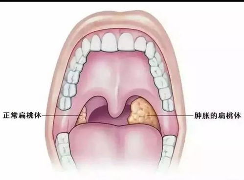 孩子扁桃体炎,喉咙痛怎么办 附小儿推拿方案