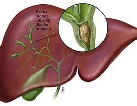 常见的肝内胆管结石有哪些典型症状