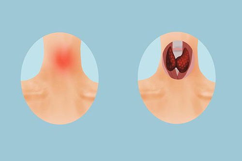 甲状腺结节和囊肿的区别在哪方便你有了解吗