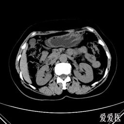 肝脏CT