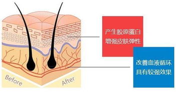 什么是线雕,线雕提升能维持多久