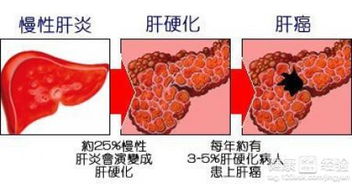 肝硬化患者调理生活