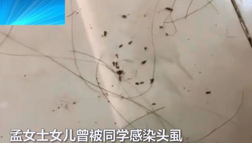 广东10岁女孩被同学传染头虱,母亲拿出热夹板,烫出20多只头虱