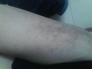 我大腿外侧有黑斑有一 