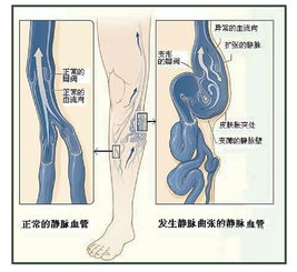 静脉曲张危害?静脉曲张怎么预防？