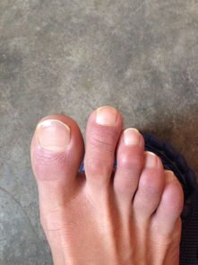 第二个脚指头比较长,如果鞋子小一点的话第二个指头就卡疼,为什么第二个脚趾会长 这样的脚趾有什么特点 