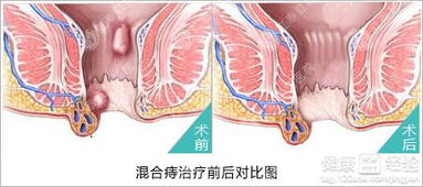 混合痔挺严重的，有什么办法治吗只能手术吗(混合痔最严重的后果是什么)