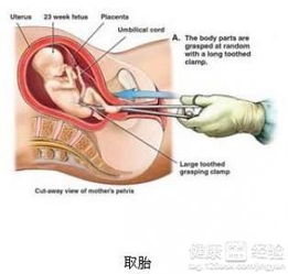 人流手术要多长时间