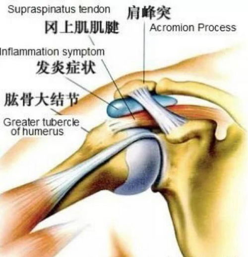 健身训练干货,肩峰撞击,85 肩痛患者的症结所在