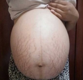 妊娠纹是什么样的，怀孕期间长妊娠纹有什么征兆吗,刚开始长是什么样子啊