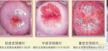 中度宫颈糜烂的治疗