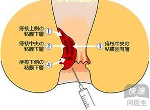 内痔疮疼吗(内痔疮疼吗?)