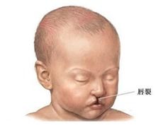 天使科普 唇腭裂宝宝喂养及护理的的正确方法