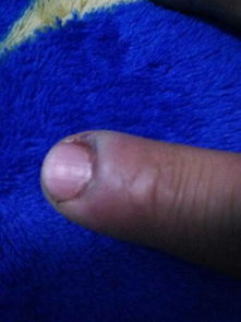 右手食指指甲边昨天晚上一开始感到痛 ,今天早上一看肿了 才发现里面化脓了 就把脓弄出来了 