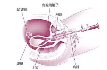 宫腔镜是什么检查 宫腔镜手术跟检查的区别